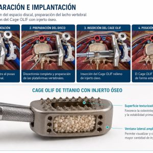 NUEVA TÉCNICA PARA CIRUGÍAS DE COLUMNA LLEGA A ECUADOR Y AMPLÍA LAS OPCIONES PARA PACIENTES CON DOLOR LUMBAR